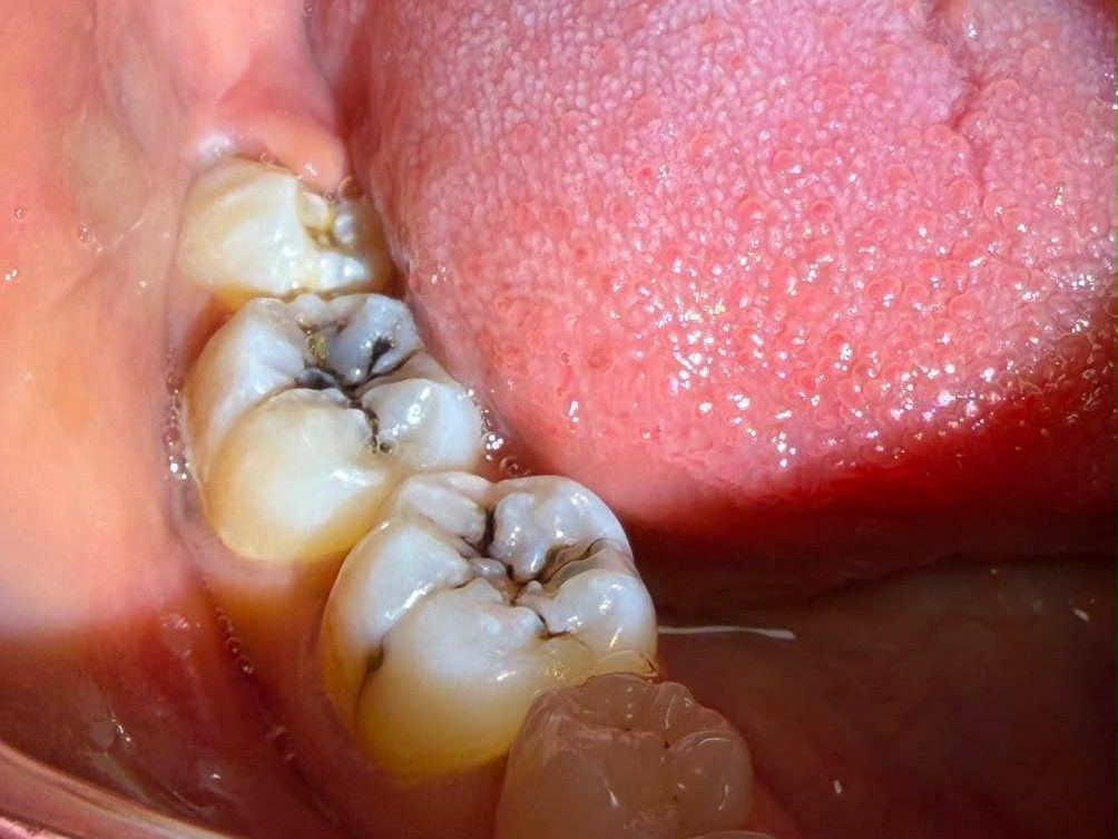 Caries des molaires, avant le traitement, cabinet du Dr El Attabi à Tétouan